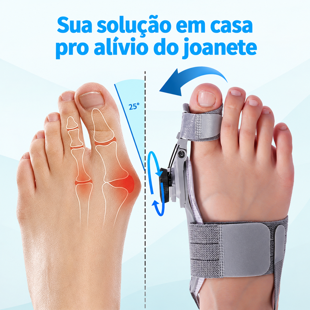 Corretor de joanete Ortevi no pé, puxando o dedão de volta pra posição natural